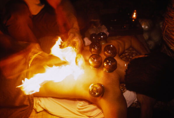 cupping the art of application of heated 